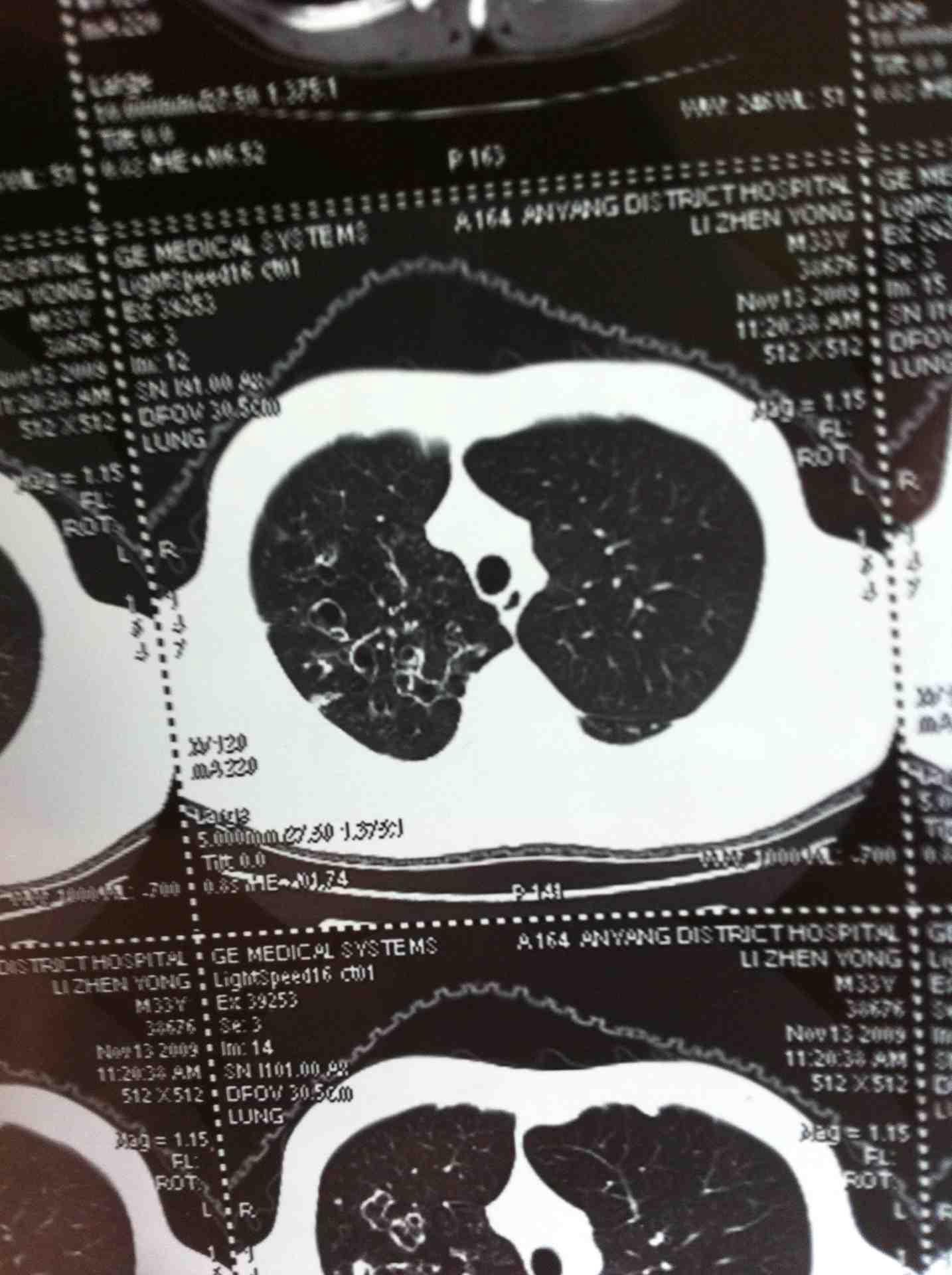 支气管扩张-怎样**引流?