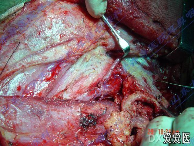 腹壁下动脉穿支皮瓣游离移植修复四肢软组织缺损的观察与护理图片