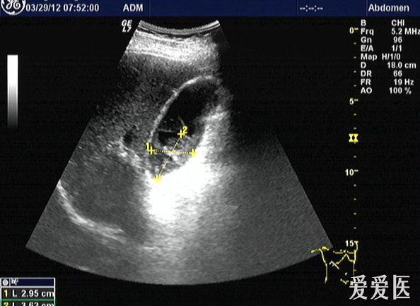 诡异的胆囊异物 超声医学讨论版 爱爱医医学论坛