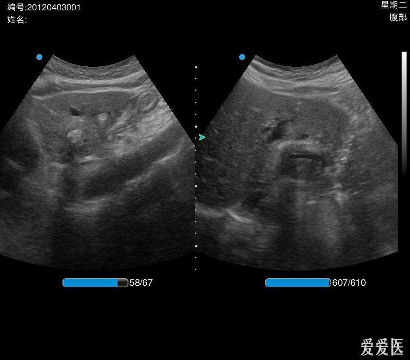 肝内胆管结石 - 超声医学讨论版 - 爱爱医医学论坛