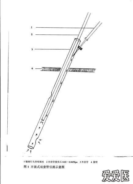临床上关于【滴水双套管】的知识