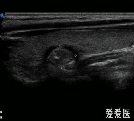 考虑食管憩室可能性大,建议进一步检查_zengerya 超声医学讨论版