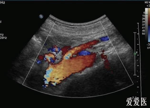 左肾静脉压迫综合征_zengerya - 超声医学讨论版 - 医