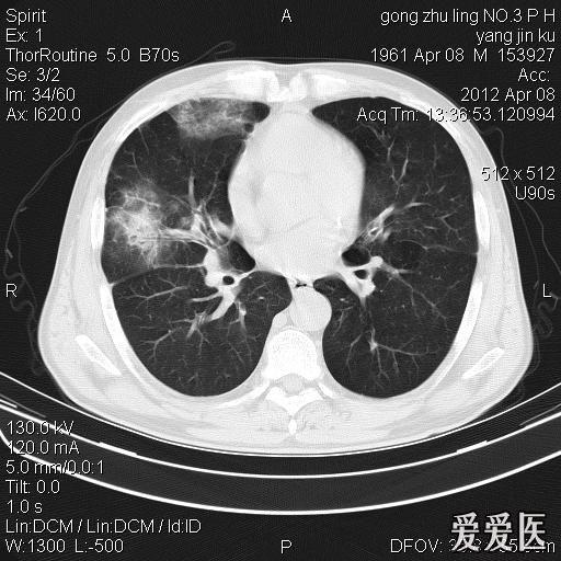 肺部病例,肺脓肿,除外其他不? - 医学影像学讨论版 - 爱爱医医学论坛