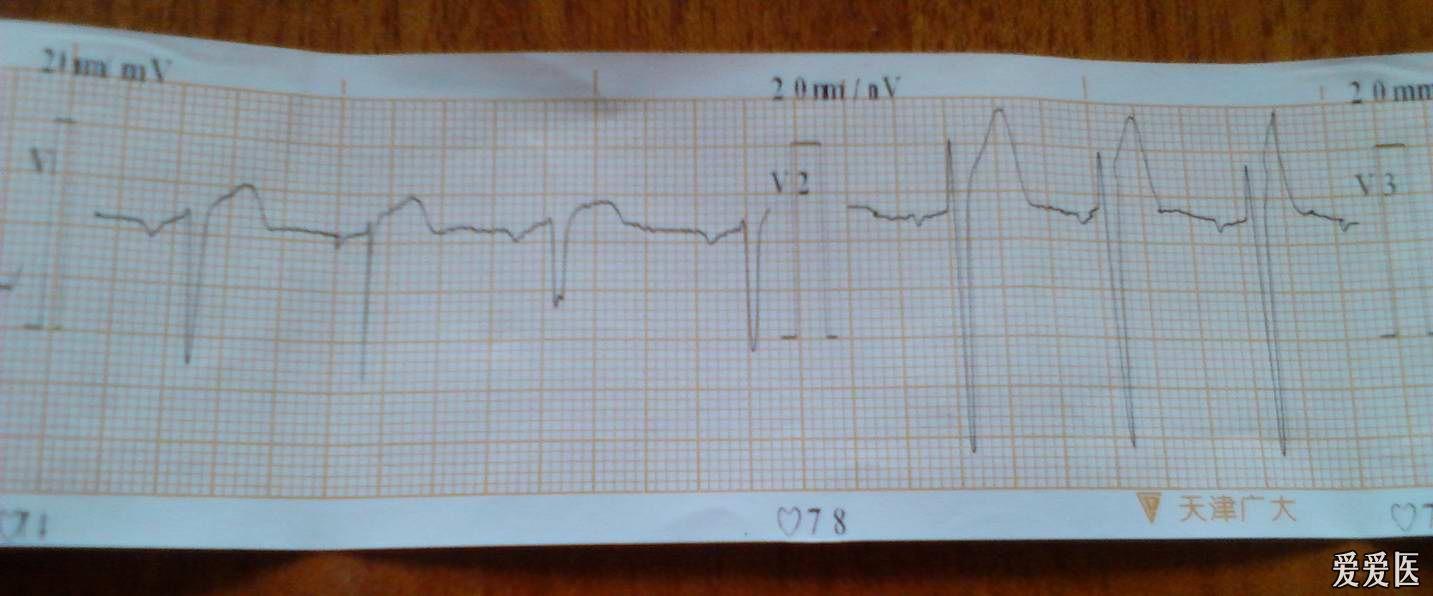 这个胸导联心电图怎么看呢