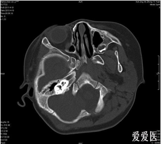 右枕部皮下结节