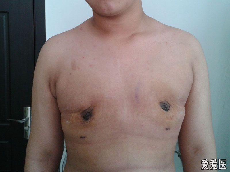 求助男孩乳房及乳头增大