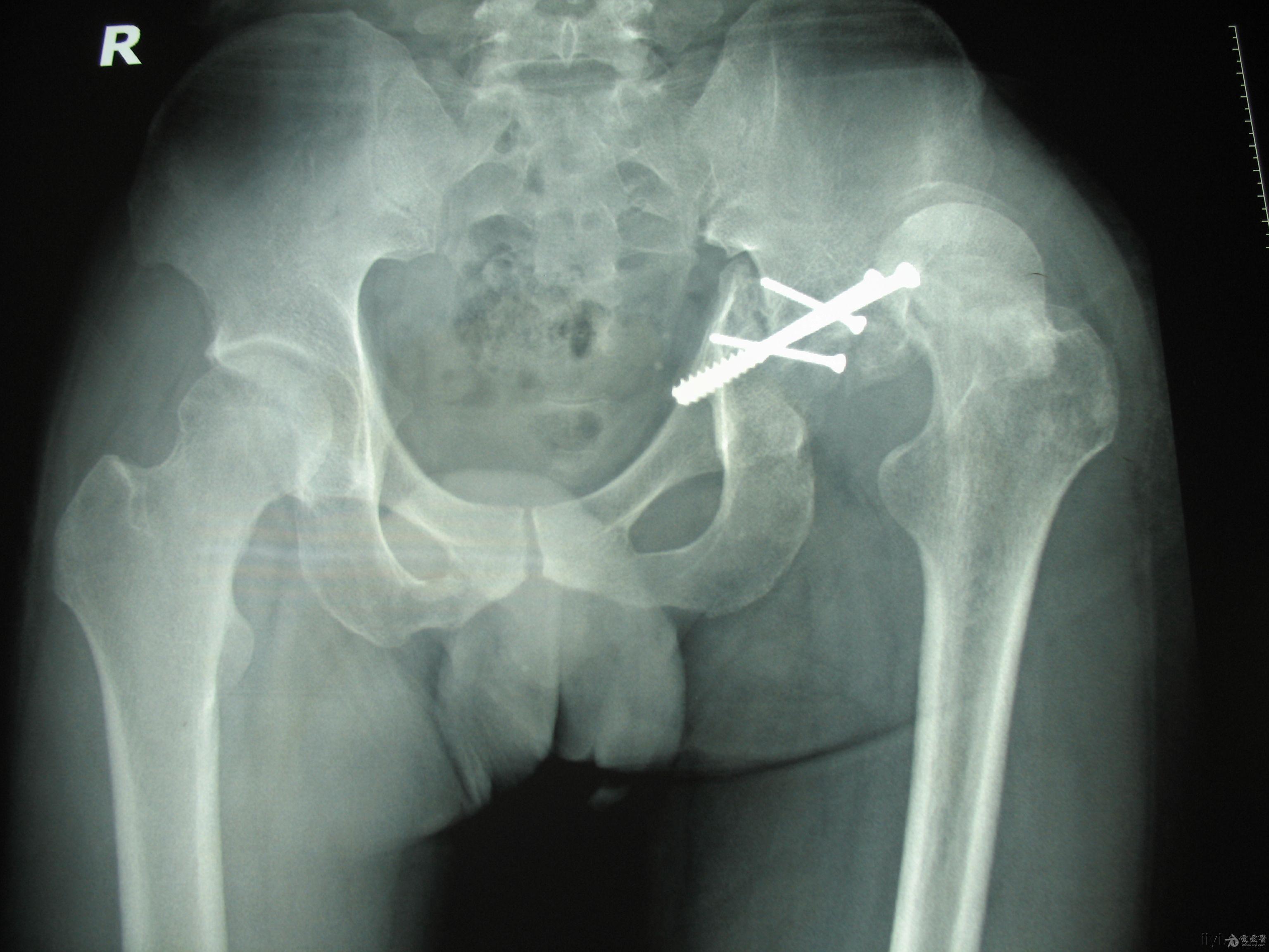 患者,男,67岁,因车祸胫腓骨近端开放性骨折,行切开复位锁定钢板内