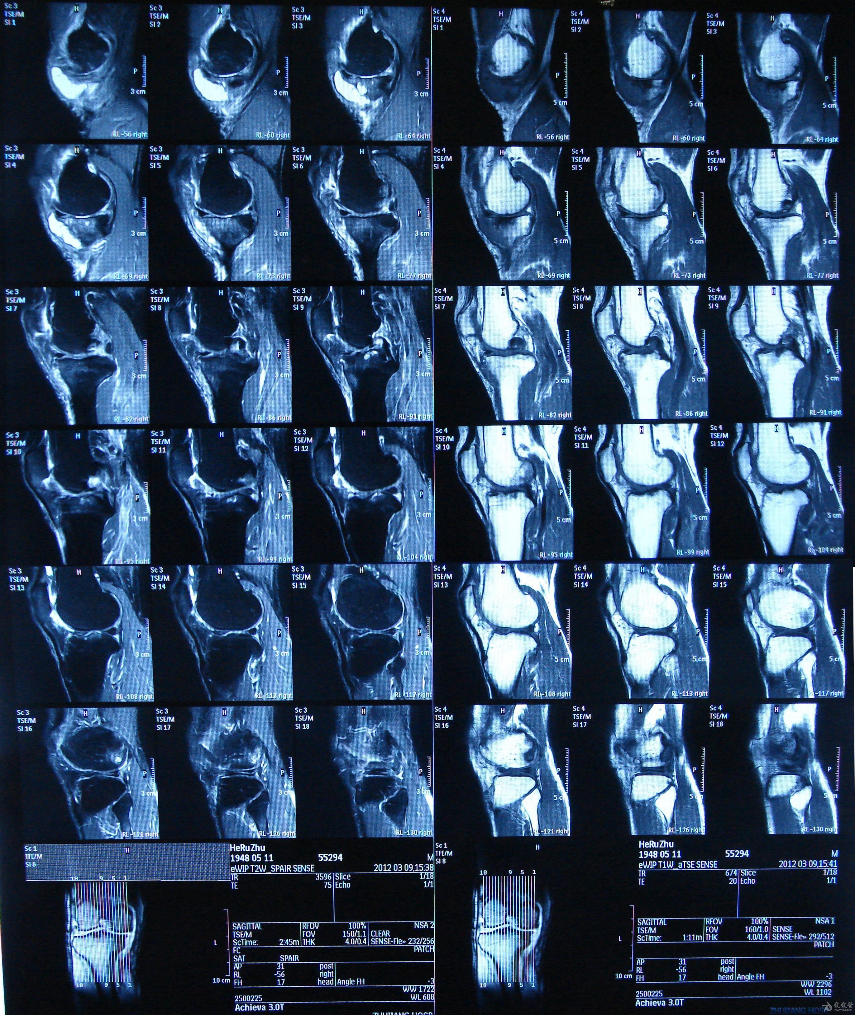 膝关节囊肿需手术切除吗