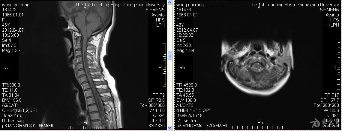 一例小脑扁桃体下疝