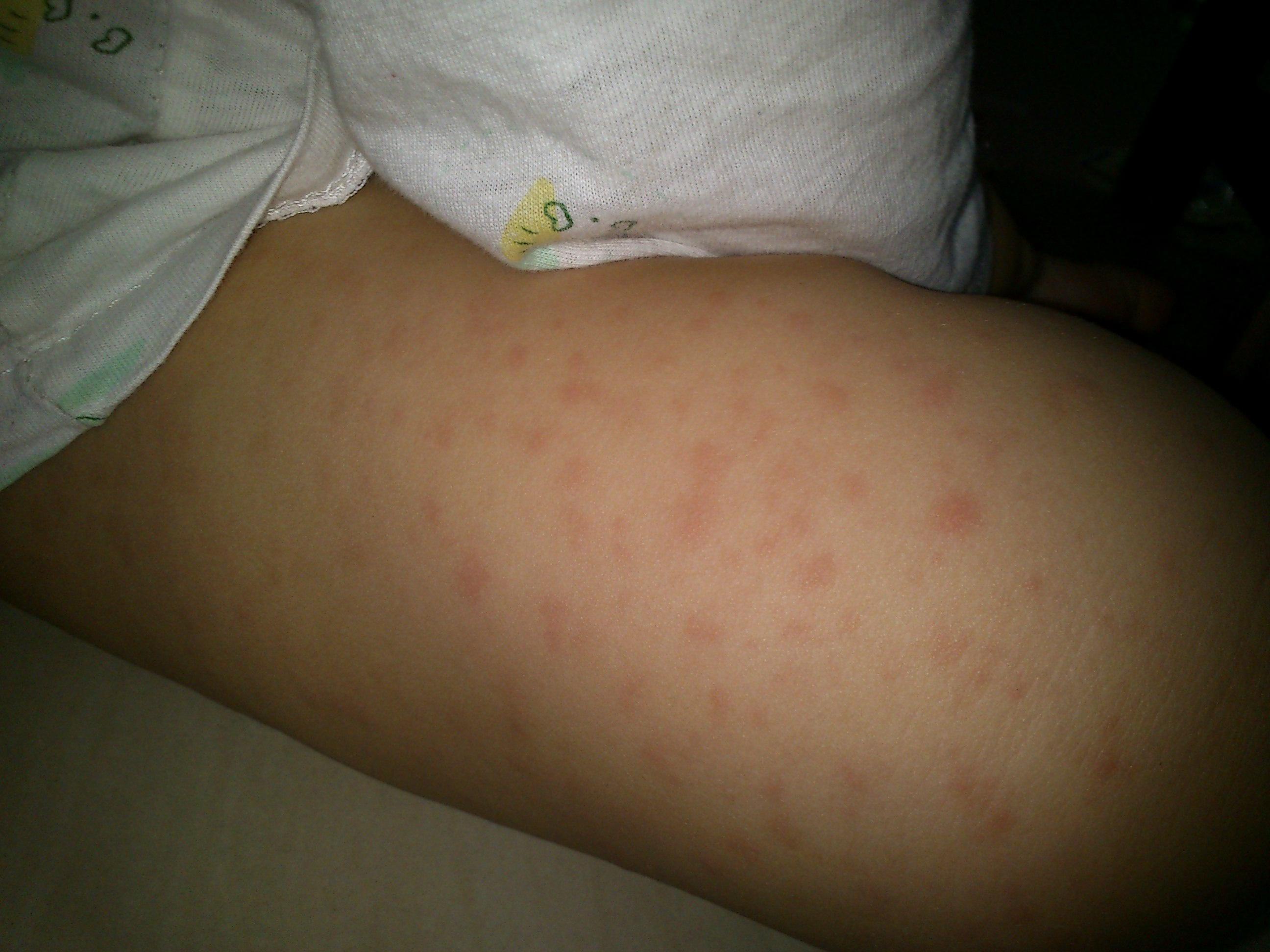 这是小儿麻疹还是风疹?还别的什么?