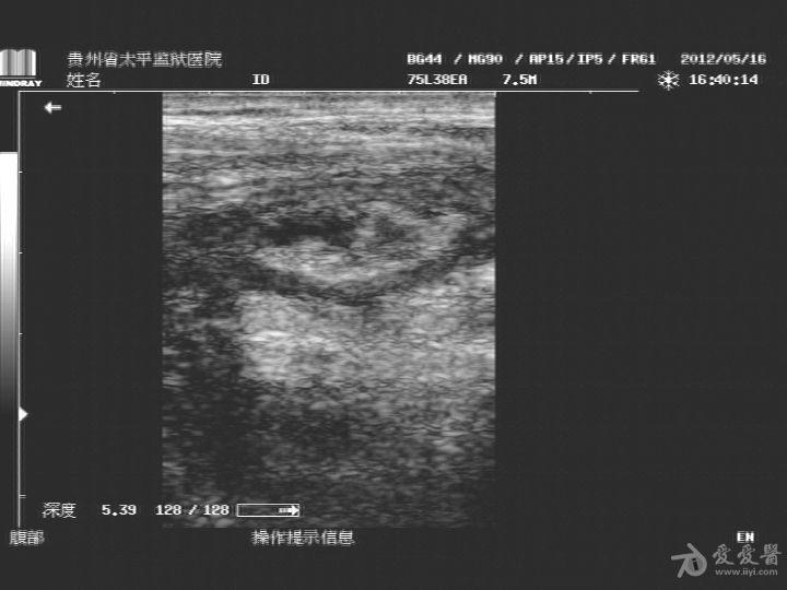 是否阑尾炎 - 超声医学讨论版 - 爱爱医医学论坛