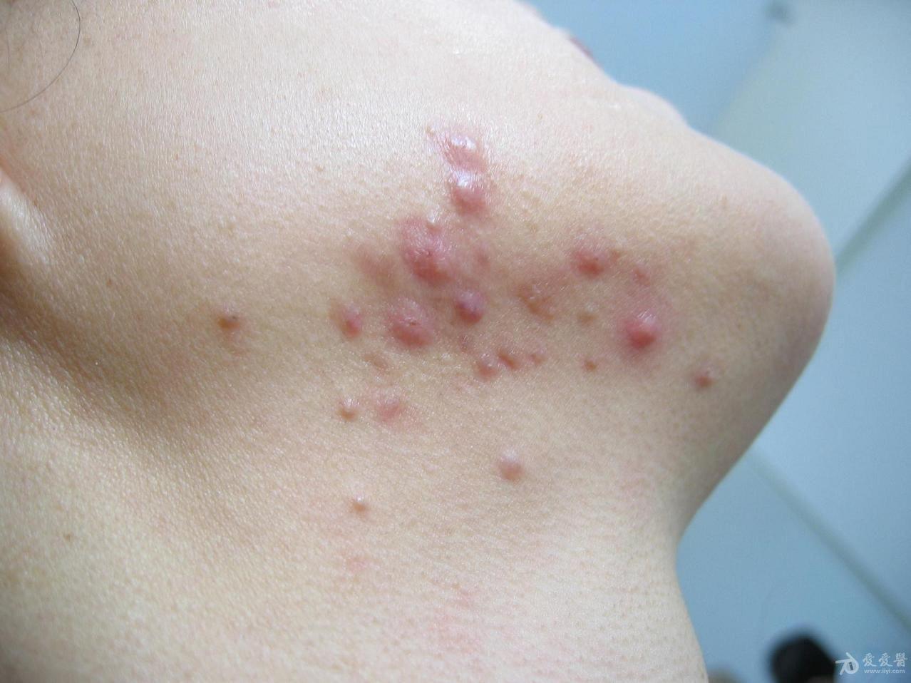[皮肤病] 糠粃孢子菌毛囊炎