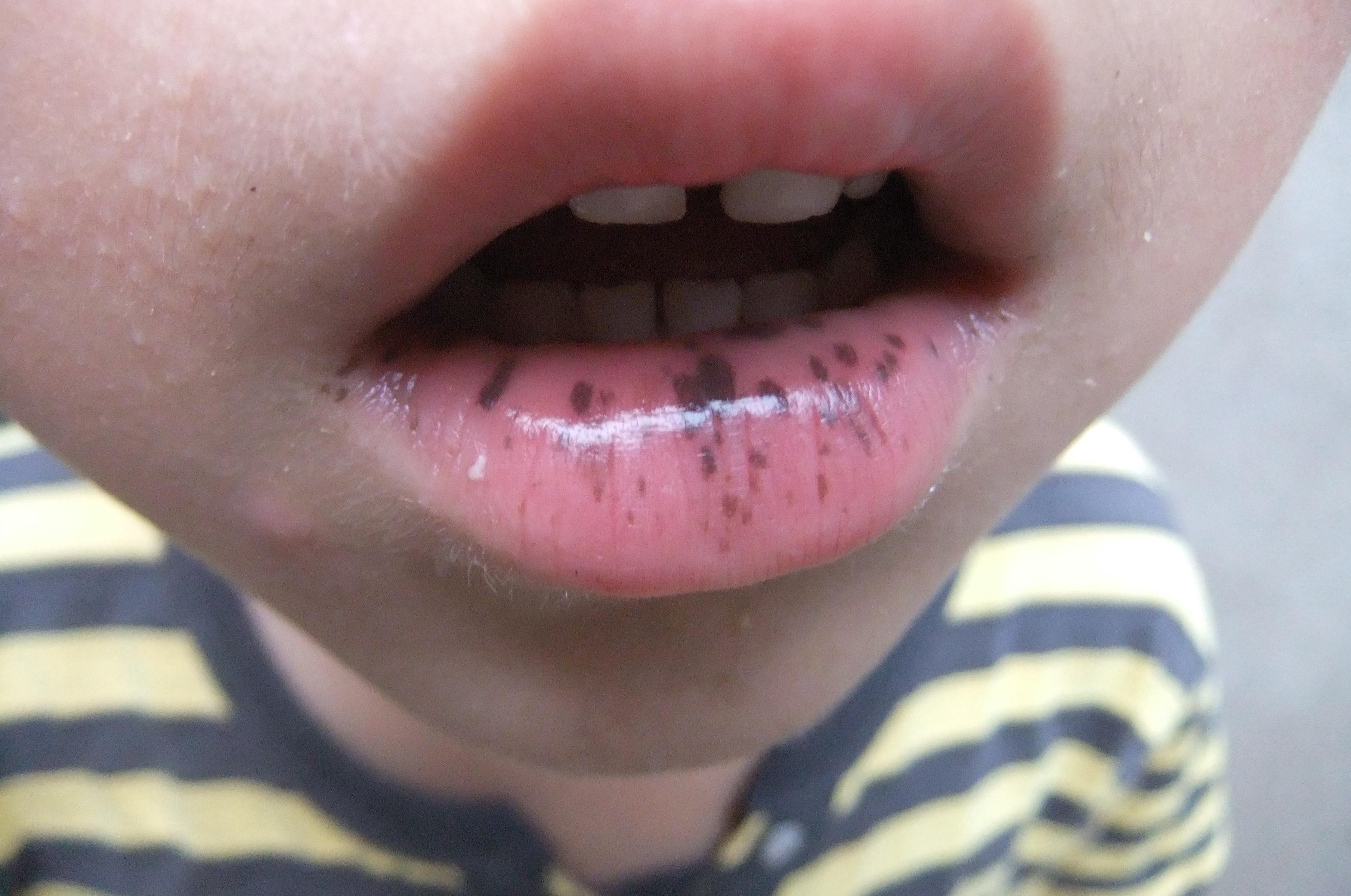 7岁患儿口腔黏膜和口唇上长得是什么