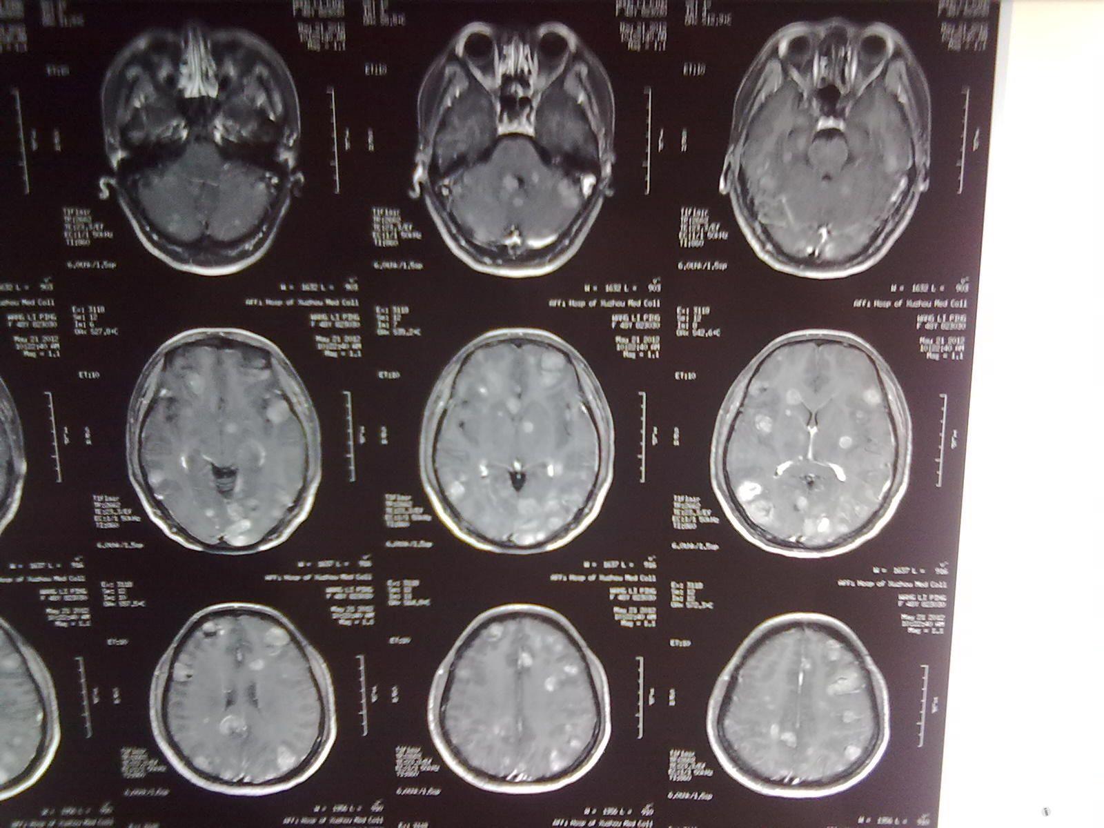 脑梗死：CT vs 磁共振 - 知乎