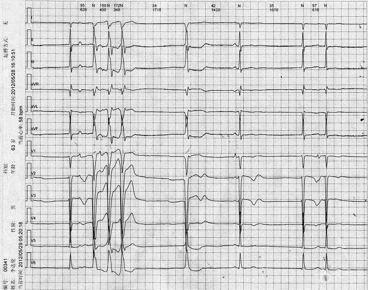 男63岁-扩张性心肌病病窦组图-5.jpg