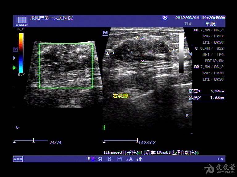 乳腺癌伴腋窝淋巴结转移 超声医学讨论版 爱爱医医学论坛