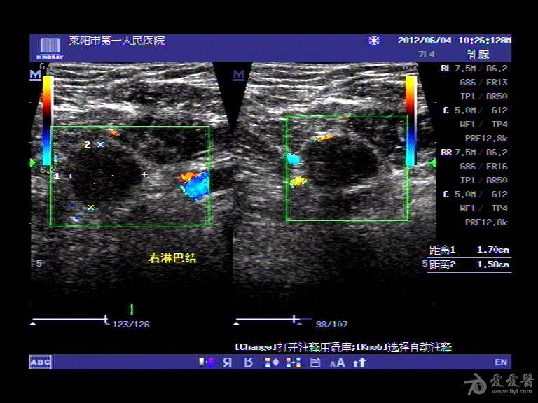 乳腺癌伴腋窝淋巴结转移 超声医学讨论版 爱爱医医学论坛