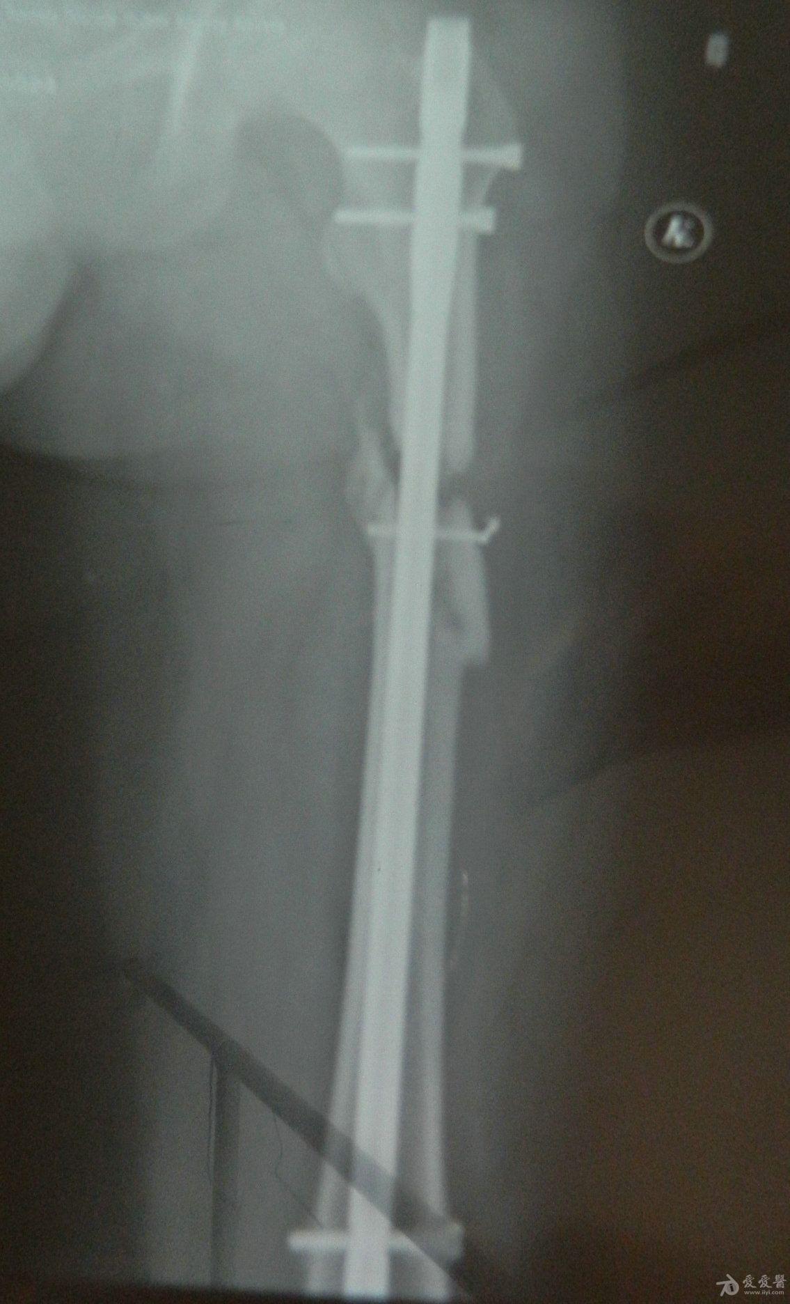股骨干骨折术后骨不愈合附图