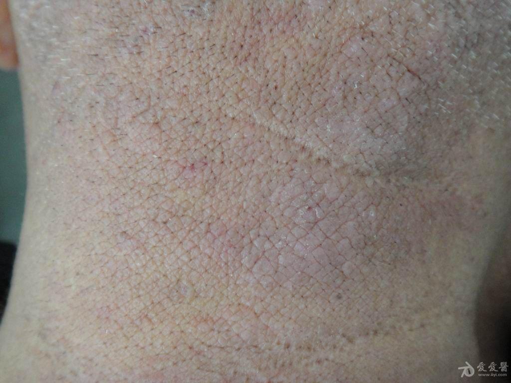 [皮肤病] 神经性皮炎