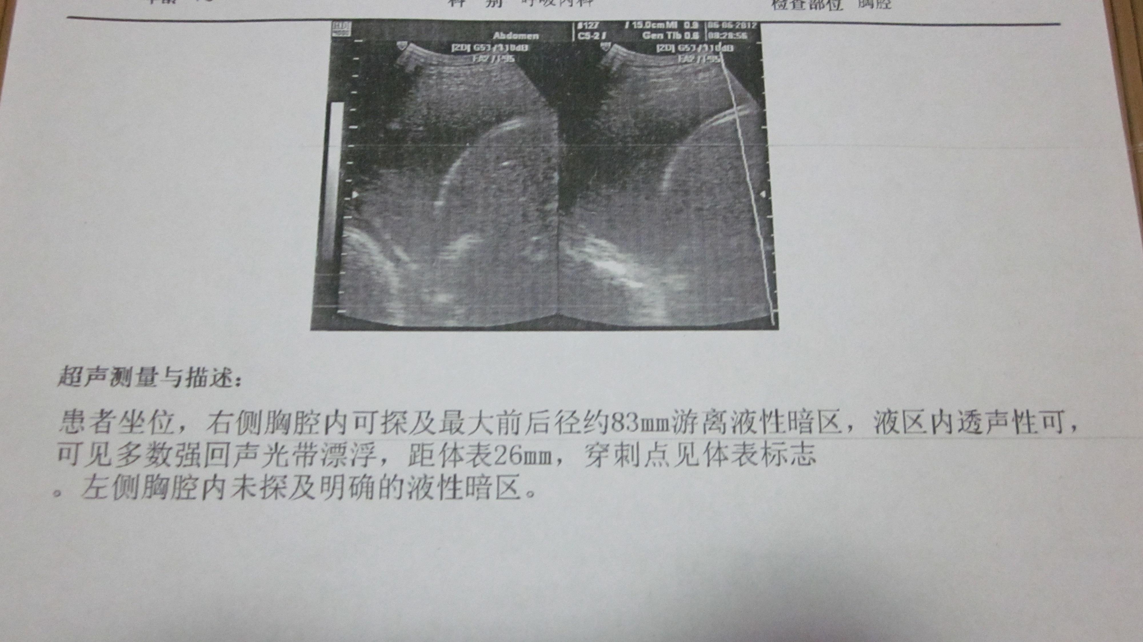 肺部积水好治疗吗