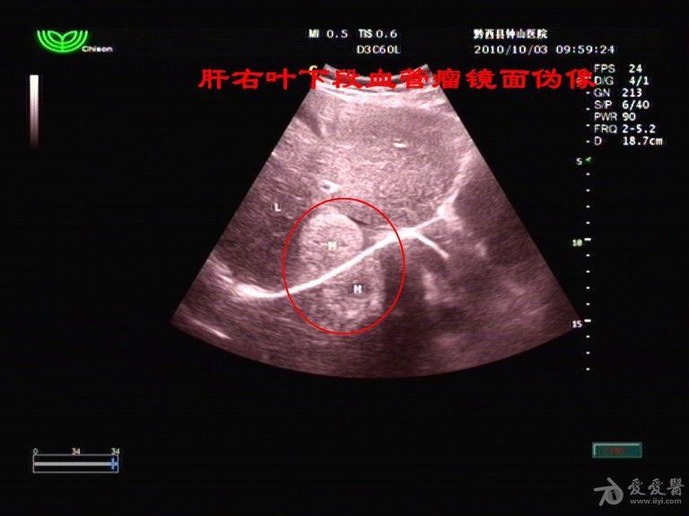 肝血管瘤镜面伪像 超声医学讨论版 爱爱医医学论坛