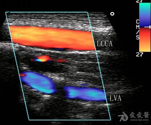 锁骨下动脉窃血综合征——zengerya - 超声医学讨论版
