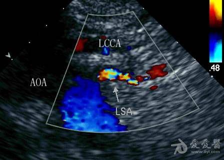 锁骨下动脉窃血综合征——zengerya - 超声医学讨论版