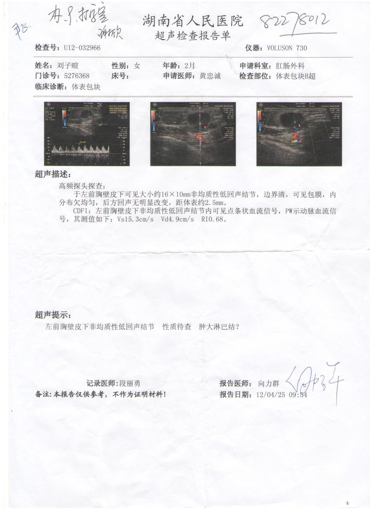 儿童接种卡介苗患淋巴结