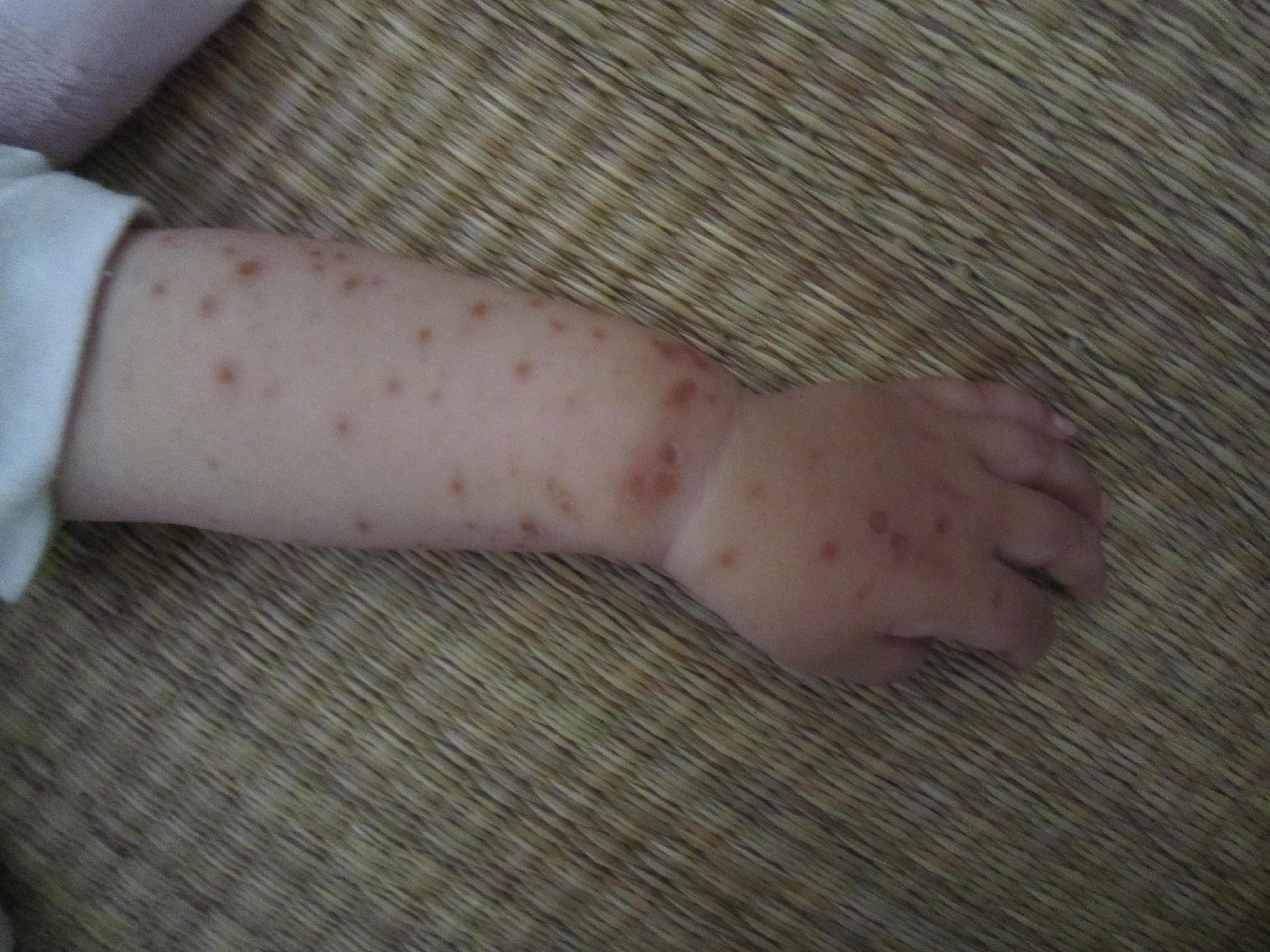 求助最近科室两例儿童皮疹