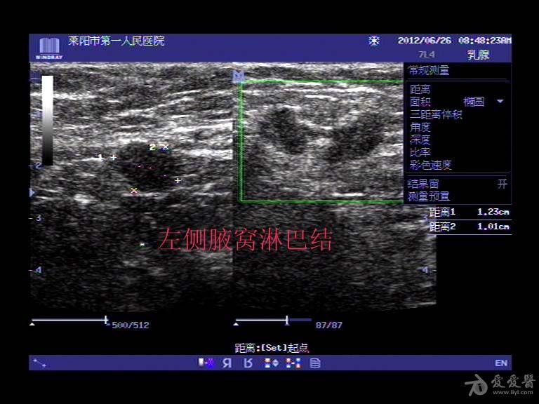 乳腺癌伴腋窝淋巴结转移 超声医学讨论版 爱爱医医学论坛