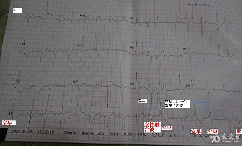 室早-室性融合波.jpg