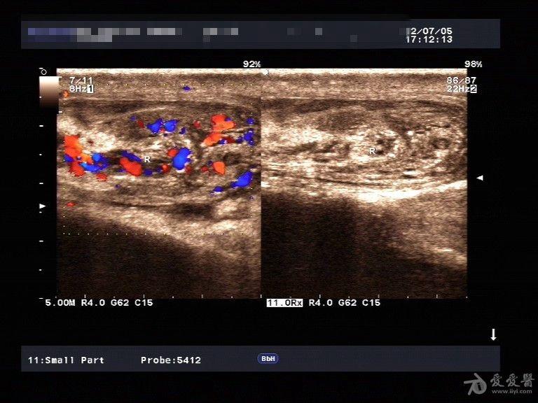 精索附睾炎一例. - 超声医学讨论版 - 爱爱医医学论坛