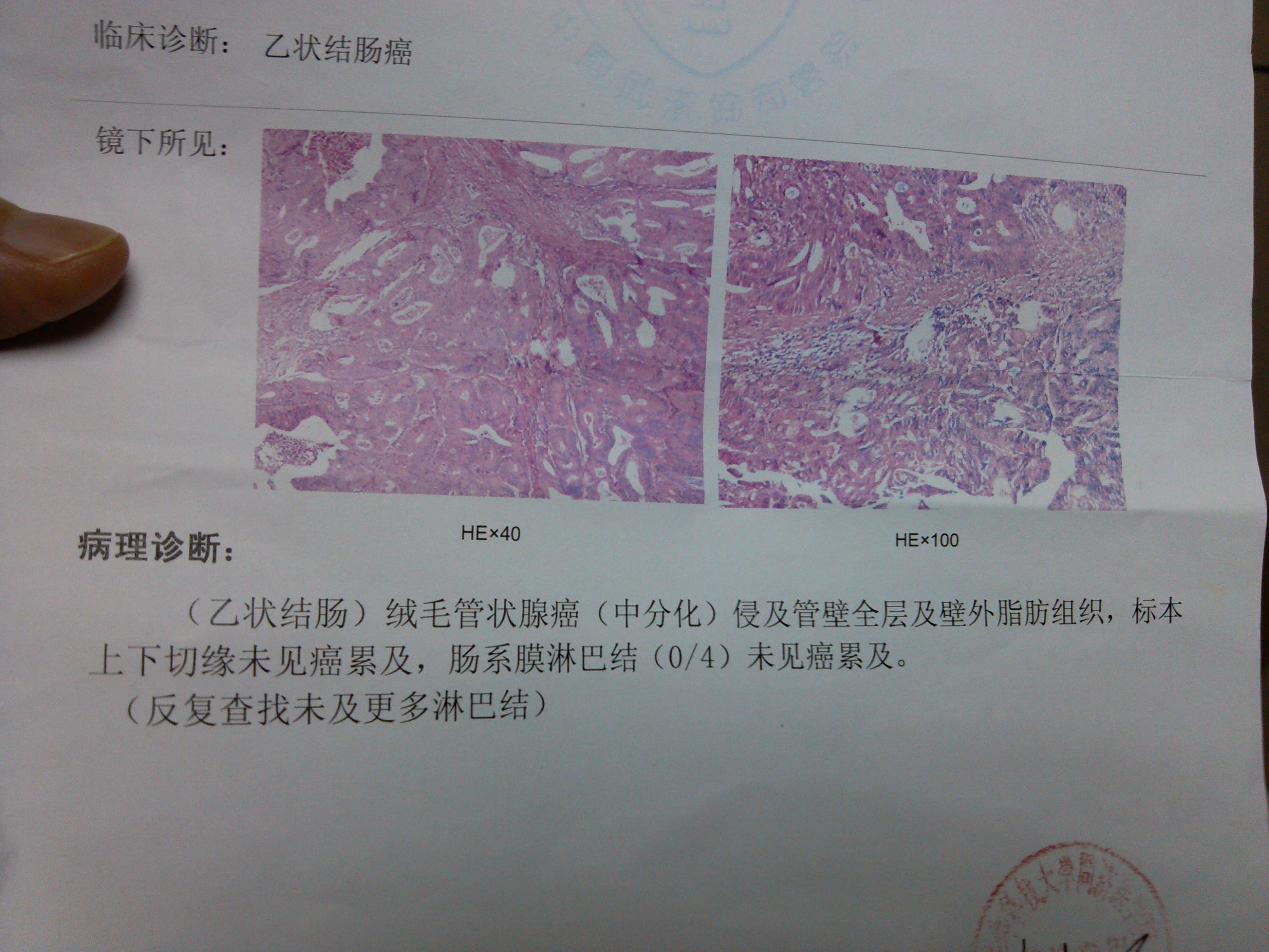 乙状结肠癌术后9天突然出现腹痛