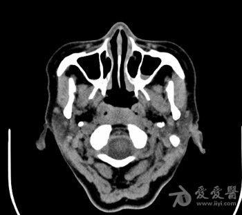 右侧鼻咽侧壁稍增厚颈部淋巴结增大