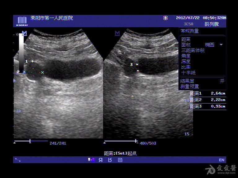 膀胱憩室 超声医学讨论版 爱爱医医学论坛
