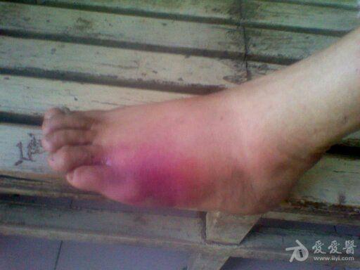 阿莫西林迟发性过敏药疹
