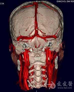 颈动脉,锁骨下动脉及颅内动脉cta几张图片
