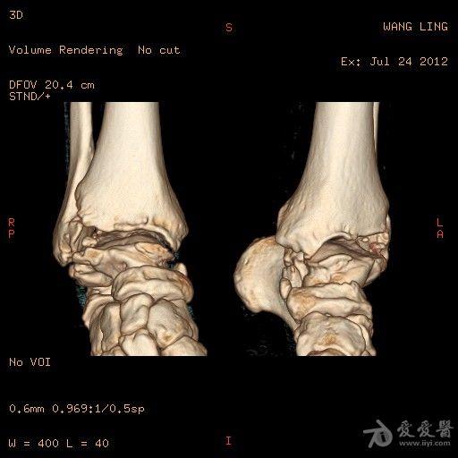 距骨病变-很典型的大骨节病2012.8.18. - 医学影像学