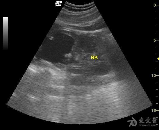 右肾重复肾输尿管畸形