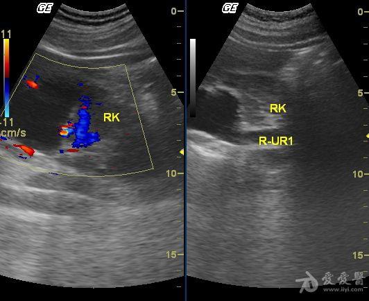 右肾重复肾,输尿管畸形 超声医学讨论版 爱爱医医学论坛