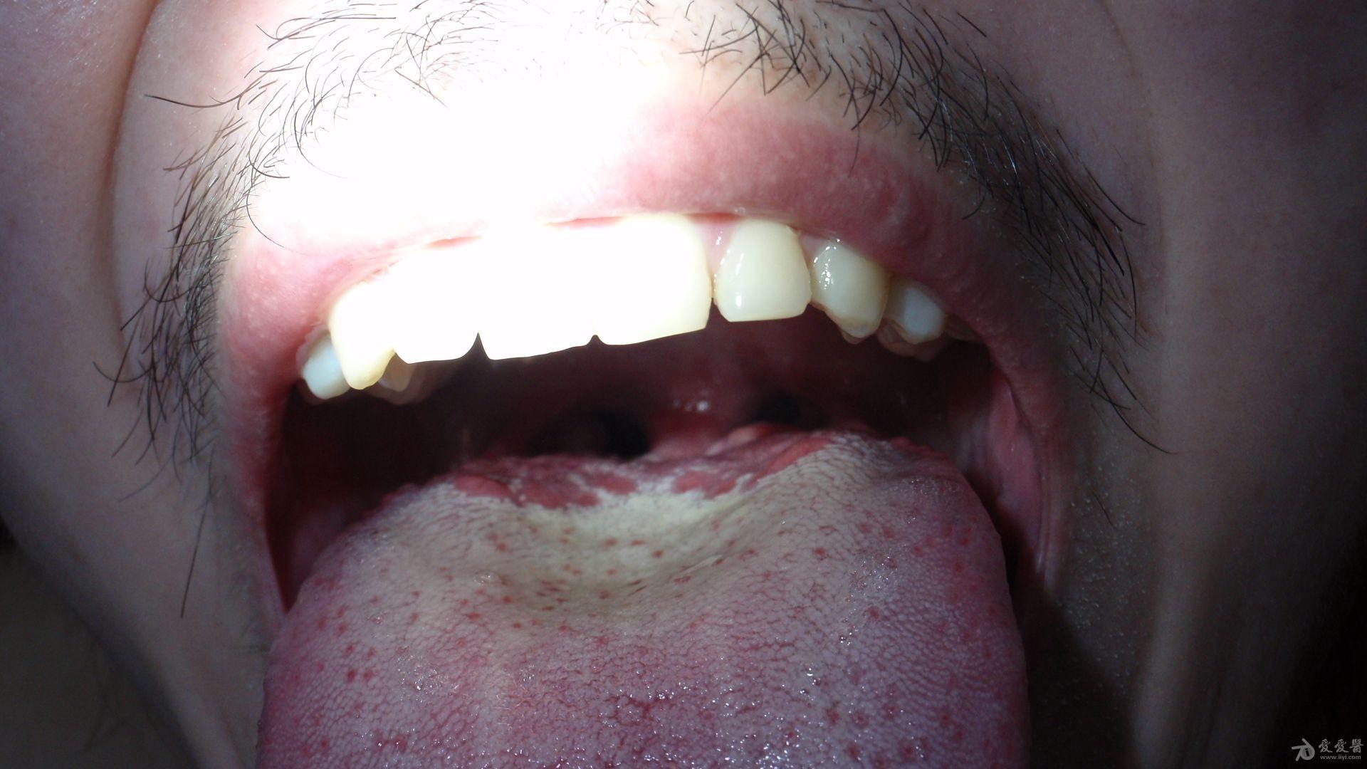 舌乳头炎都有哪些症状表现？-京东健康