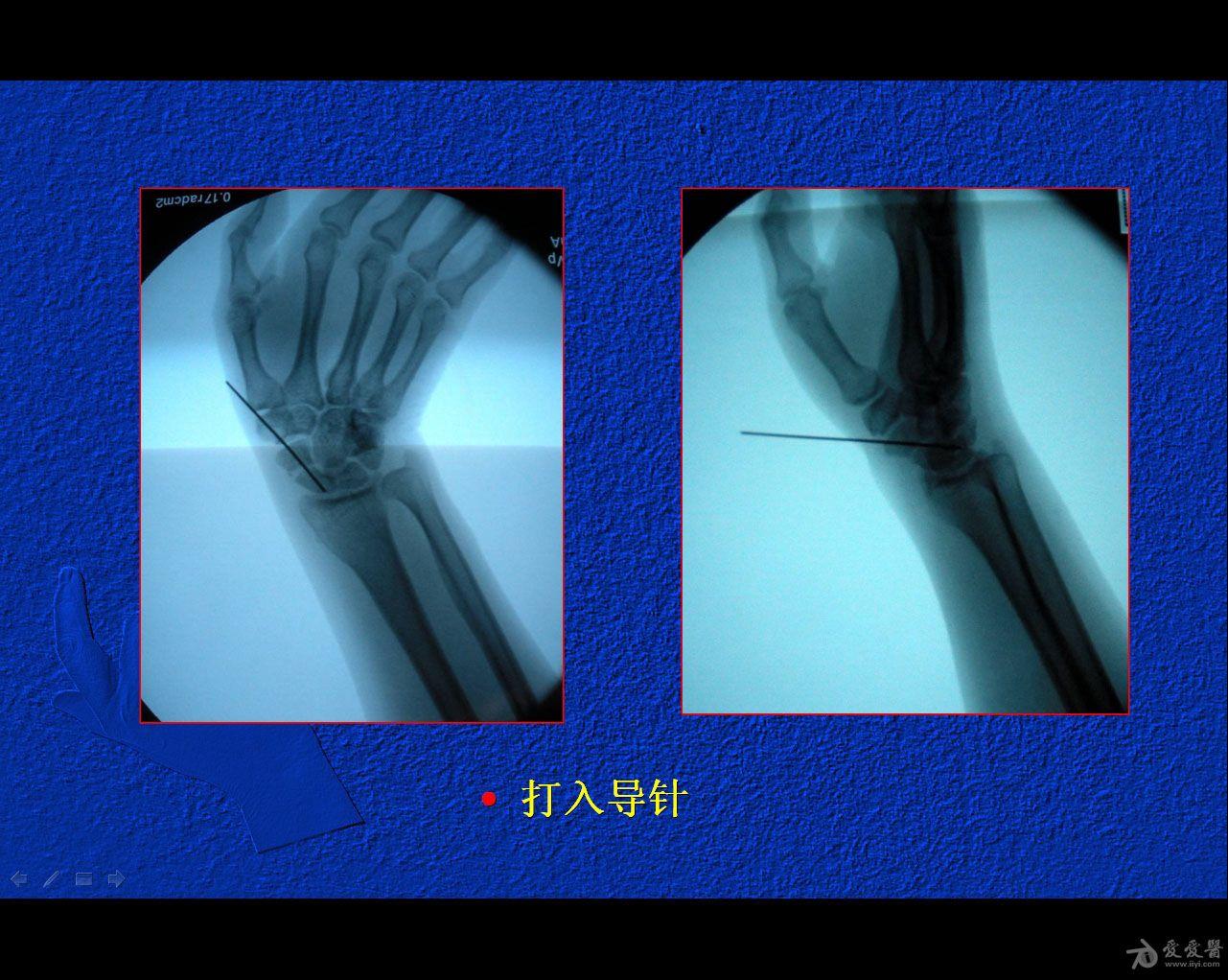 闭合复位经皮埋头空心螺钉治疗腕舟骨骨折50期读片会