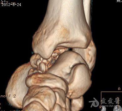 距骨骨折伴踝关节半脱位诊断处理