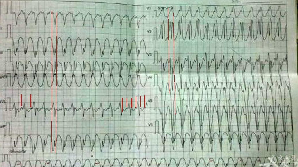 一个病人的心电图讨论下诊断快心室率qrs波群宽大畸形