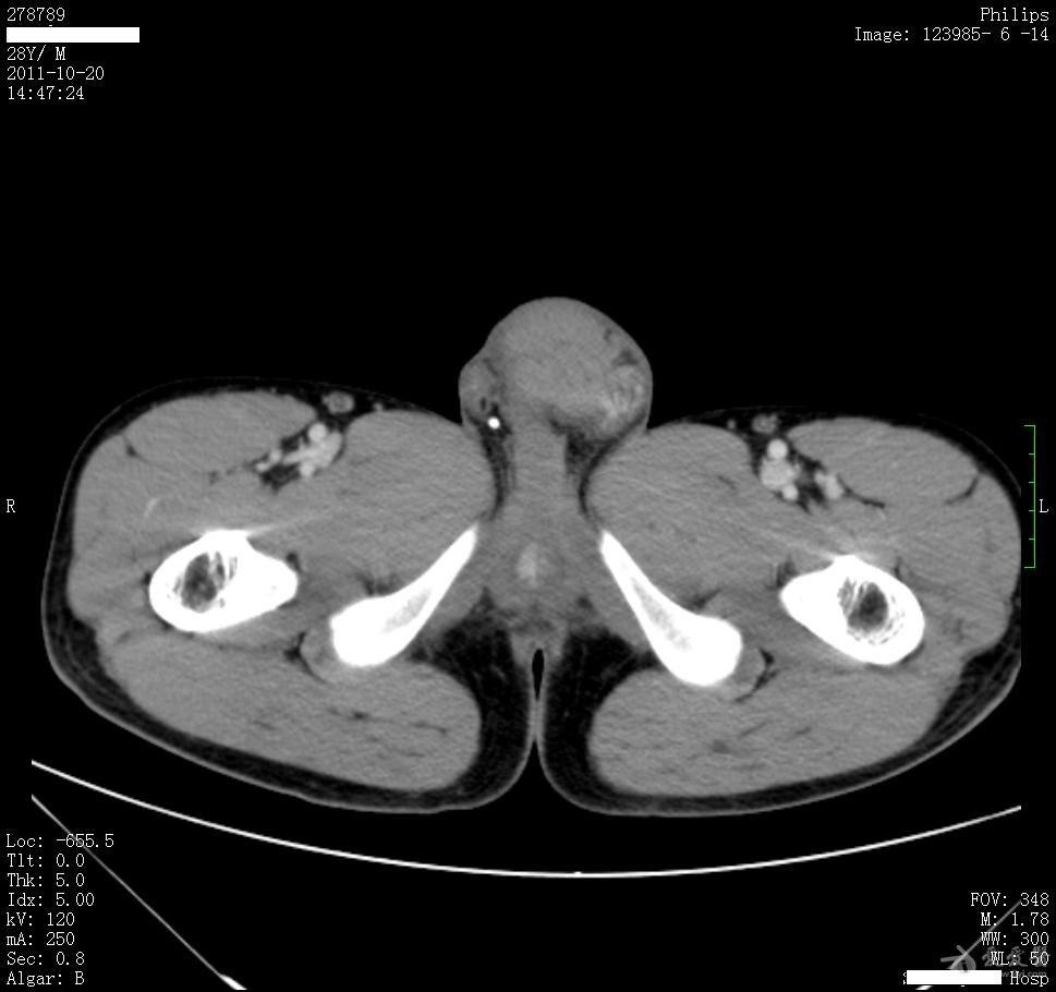 病例15睾丸肿大5月余结果在6楼