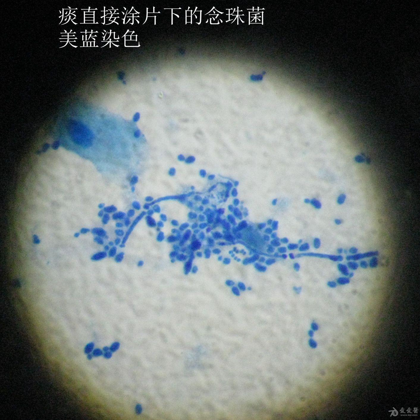 显微镜下的美丽-痰直接涂片下的念珠菌 下图为痰直接涂片找真菌