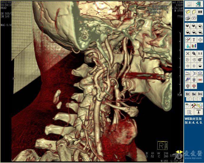 国内最好的动脉血管造影图,该患者有颈动脉斑块,影像清晰可见,目前