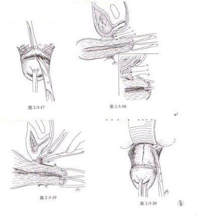 手术难点技巧图解二:经阴道全子宫切除术(一)