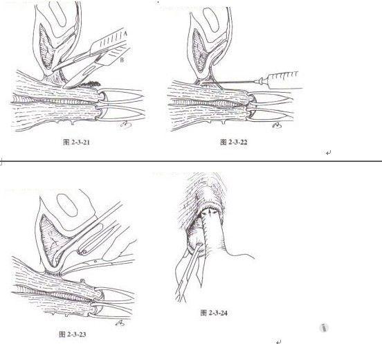 手术难点技巧图解二:经阴道全子宫切除术(一)